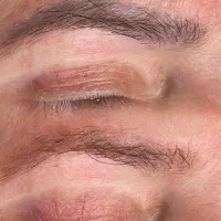 لیزر تتو ابرو خط چشم بدن