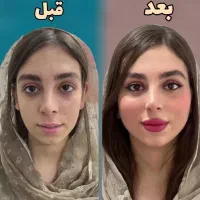 فیلر بادی سینه باسن واژن دست/ژل لب فیس لاغری آف۵۰٪