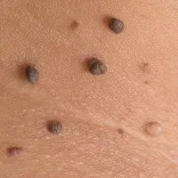 خال،ردِ بخیه،کلوئید،پاک کردن تاتو،سوختگی