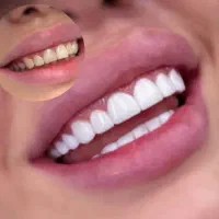 جشنواره ویژه کامپوزیت دندان هرفک فقط و فقط۹۳۰۰