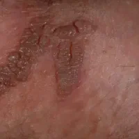 راه نجات بیماری زگیل و تبخال