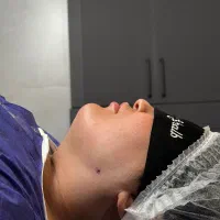 ساکشن غبغب توسط پزشک مطب کلینیک ۷ میلیون