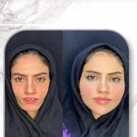 لیفت BAU فیس لیفت صورت اصلاح افتادگی لاغری صورت|خدمات آرایشگری و زیبایی|مشهد, هفت تیر (حافظ)|دیوار