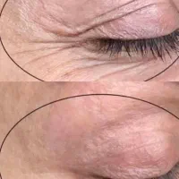 رفع کامل چین و چروک طی یک دوره