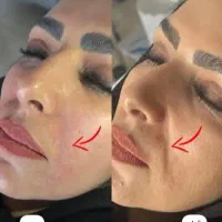 آموزش ژل و بوتاکس نیدلینگ|خدمات آموزشی|رفسنجان, |دیوار