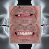 3 واحد ایمپلنت1واحد رایگان/جشنواره ایمپلنت دیجیتال|خدمات آرایشگری و زیبایی|تهران, هروی|دیوار