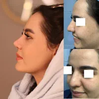 جراحی بینی در تهران با آف ۵۰درصد،جشنواره آذر