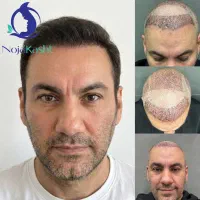 نژا کاشت مجموعه تخصصی کاشت مو و ابرو از سال 1383