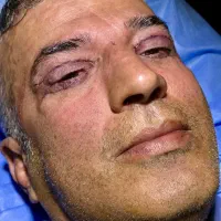 جراحی پلک توسط متخصص چشم و فوق تخصص شبکیه ۱۵