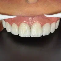 ایمپلنت دیجیتال فقط با 5 تومان اقساطی