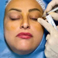 جشنواره بلفاروپلاستی جراحی پلک با بخیه لیزری