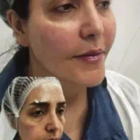 تزریق ژل/بوتاکس/جراحی زیبایی زنان/فشیال/مزو