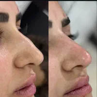 کانتورینگ لیفت فیلر بوتاکس مزو|خدمات آرایشگری و زیبایی|اصفهان, سپاهان‌شهر|دیوار