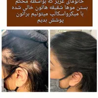 میکرو اسکالپ|خدمات آرایشگری و زیبایی|تهران, جنت‌آباد جنوبی|دیوار