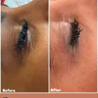 تخفیف ۵۰ درصدی فیشال و پاکسازی پوست