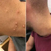 نابودی hpvزگیل ووتبخال