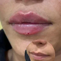 تزریق ژل و بوتاکس