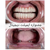دندانپزشکی/مرکزایمپلنت دیجیتال5100تومان/کاشتدندان