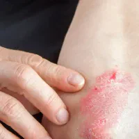 لک های پوستی،راهکار نوین مراقبت پوست مبتلا به پیسی|آرایشی، بهداشتی، درمانی|شیراز, شاهچراغ|دیوار
