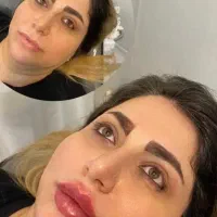 مطب زیبایی مزو.بوتاکس.فیلر