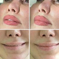 جشنواره باور نکردنی ویژه. ژل و بوتاکس.فیلر مزو ژل|خدمات آرایشگری و زیبایی|شیراز, سینما سعدی|دیوار