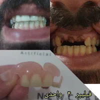 دندان مصنوعی متحرک جایگزین ایمپلنت بصورت آنی|آرایشی، بهداشتی، درمانی|رشت, گلسار|دیوار