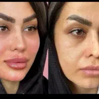 تزریق ژل بوتاکس و ساکشن تزریق چربی درکلینیک|خدمات آرایشگری و زیبایی|کرمانشاه, |دیوار