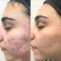 کرم بیوممتیک ضد جوش ۱۰ کاره