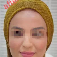 بوتاکس رایگان با انجام دو سی سی فیلر پیروزی|خدمات آرایشگری و زیبایی|تهران, چهارصد دستگاه|دیوار