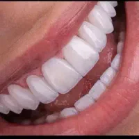 کامپوزیت دندان با چک صیادی