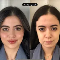جشنواره تزریق ژل و بوتاکسوکانتورصورت وآموزش