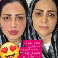 تزریق ژل و بوتاکس و مزو ژل|خدمات آرایشگری و زیبایی|فسا, |دیوار