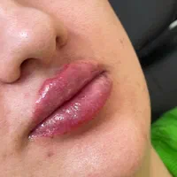 ژل و بوتاکس ‌‌پاکسازی|خدمات آرایشگری و زیبایی|مشهد, شهید معقول|دیوار