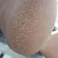 پاکسازی کف پا ۳۵۰