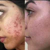 خاویار حلزون