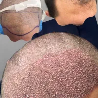 کاشت تخصصی مو و ابرو