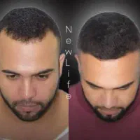 کاشت مو Vipدریک جلسه باتراکم بالا