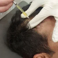 جشنواره 50% تزریق پروتئین ،PRPمعجزه ترمیم پوست