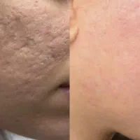 از بین بردن لک و جای جوش فرورفته صورت گچساران|خدمات آرایشگری و زیبایی|دهدشت, |دیوار