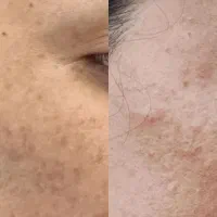 حذف دائمی کک و مک|خدمات آرایشگری و زیبایی|تربت جام, المهدی|دیوار