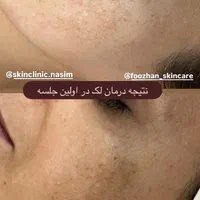 آموزش لیفت و جوانسازی پوست|خدمات آرایشگری و زیبایی|تهران, گیشا|دیوار