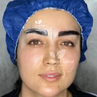 جشنواره قسطی کاشت ابرو موبلفاروپلاستی غبغب
