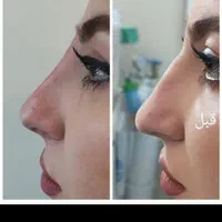 تزریق ژل لب ب روش روسی آنباکسش توسط زیباجو|خدمات آرایشگری و زیبایی|مشهد, پنجتن|دیوار