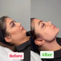 تخلیه چربی غبغب|خدمات آرایشگری و زیبایی|تهران, ایوانک|دیوار