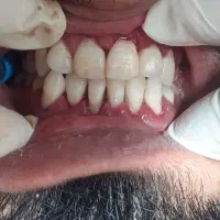 انجام جرمگیری هر فک فقط ۴۵۰ تومان در مطب شخصی|خدمات آرایشگری و زیبایی|زاهدان, |دیوار