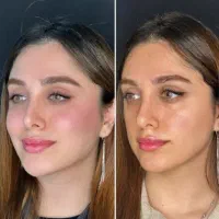 لیفت ابرو پکیج مادلینگ ژل لب بوتاکس فیلر بادی بینی