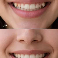 ارتودنسی شفاف نامرئی،بدون سیم + پرداخت اقساطی