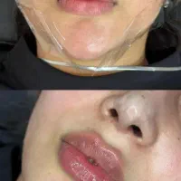 تزریق مزو فیلر بادی  ژل انزیم مادلینگ بینی زاویه