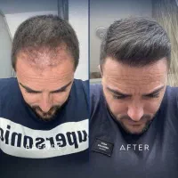 کاشت مو با جدیدترین‌دستگاه و‌بدون‌جراحی پرتراکم
