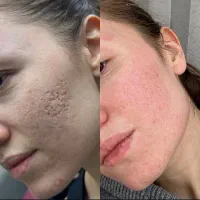 لاغری ،لیزر موهای زائد رایگان،فیلر،بوتاکس.هایفو